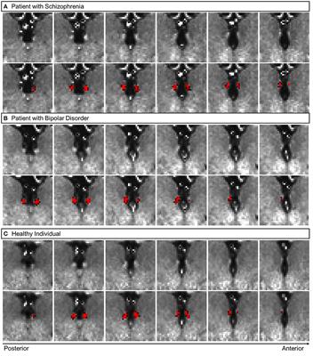 Imaging Habenula Volume in Schizophrenia and Bipolar Disorder